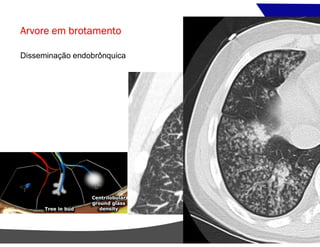 Arvore em brotamento
Disseminação endobrônquica
 