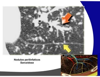 Nodulos perilinfaticos
Sarcoidose
 