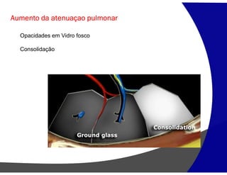 Aumento da atenuaçao pulmonar
Opacidades em Vidro fosco
Consolidação
 