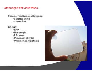 Atenuação em vidro fosco
Pode ser resultado de alterações:
no espaço aereo
no intersticio
Causas:
• EAP
• Hemorragia
• Infecçoes
• Proteinose alveolar
• Pneumonias intersticiais
 