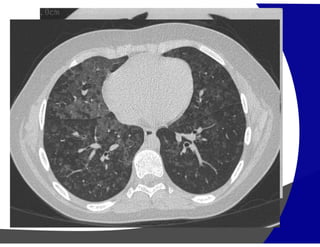 Opacidades em Vidro Fosco
(Pneumonia Descamativa Intersticial)
 
