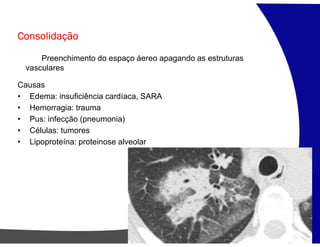 Consolidação
Preenchimento do espaço áereo apagando as estruturas
vasculares
Causas
• Edema: insuficiência cardíaca, SARA
• Hemorragia: trauma
• Pus: infecção (pneumonia)
• Células: tumores
• Lipoproteína: proteinose alveolar
 