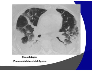 Consolidação
(Pneumonia Intersticial Aguda)
 