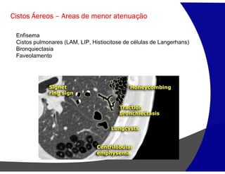 Cistos Áereos – Areas de menor atenuação
Enfisema
Cistos pulmonares (LAM, LIP, Histiocitose de células de Langerhans)
Bronquiectasia
Faveolamento
 