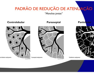 PADRÃO DE REDUÇÃO DE ATENUAÇÃO
“Manchas pretas”
Parasseptal
Centrolobular Panlobular
 
