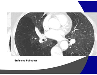 Enfisema Pulmonar
 
