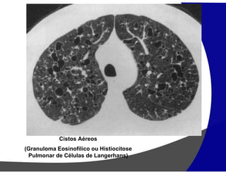 Cistos Aéreos
(Granuloma Eosinofílico ou Histiocitose
Pulmonar de Células de Langerhans)
 