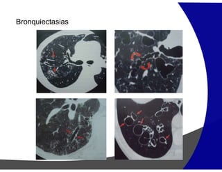 Bronquiectasias
 