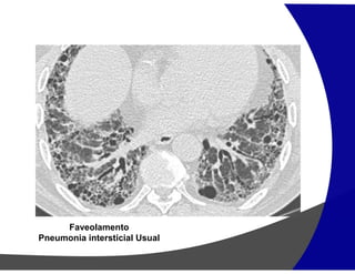 Faveolamento
Pneumonia intersticial Usual
 