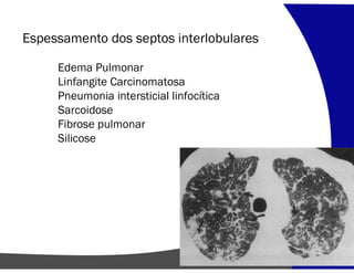 Espessamento dos septos interlobulares
Edema Pulmonar
Linfangite Carcinomatosa
Pneumonia intersticial linfocítica
Sarcoidose
Fibrose pulmonar
Silicose
 