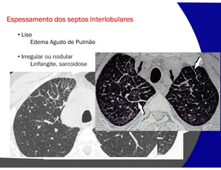 Espessamento dos septos Interlobulares
• Liso
Edema Agudo de Pulmão
• Irregular ou nodular
Linfangite, sarcoidose
 