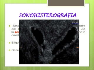 SONOHISTEROGRAFIA
 Técnica mediante la cual dentro
del , a través del cuello uterino, y se usa
la para proyectar imágenes de la
cavidad uterina.
 El líquido revela con más detalle el
 Generalmente dura unos 15 minutos.
 