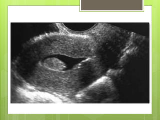  Técnica de ultrasonidos especial, mínimamente
invasiva, que proporciona imágenes del interior
del útero de la mujer.
 La histerosonografía puede evitar intervenciones
quirúrgicas innecesarias.
 