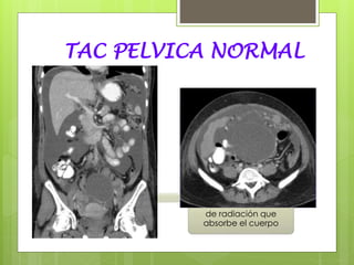 TAC PELVICA NORMAL
Numerosos haces de
rayos x
Conjunto de
detectores
electrónicos
Que rotan
alrededor del
paciente
Midiendo la cantidad
de radiación que
absorbe el cuerpo
Al mismo tiempo, la mesa
se mueve a través del
gantry con lo cual el haz
de rayos x sigue una
trayectoria en forma de
espiral.
 