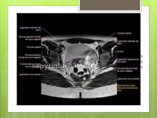 RM PÉLVICA
 Diagnosticar o reconocer la fase de anomalías de
desarrollo como leiomiomas, adenomiosis, neoplasias
vaginales, carcinoma cervical o endometrial, ovarios
poliquísticos u otras masas ováricas.
 
