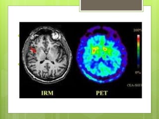  Los tomógrafos detectan los emitidos
por el paciente  producto de una aniquilación entre
un positrón, emitido por el radiofármaco, y un electrón
cortical del cuerpo del paciente.
 Se que deben detectarse al mismo
tiempo en una ventana de tiempo adecuada (ns)
para formar una imagen.
 