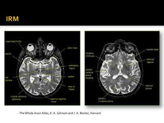 …Contd




         : The Whole-brain Atlas, K. A. Johnson and J. A. Becker, Harvard
 