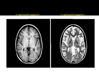 …Contd



         T1 WEIGHTED IMAGES   T2 WEIGHTED IMAGES
 