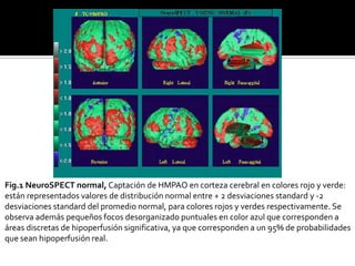 Fig.1 NeuroSPECT normal, Captación de HMPAO en corteza cerebral en colores rojo y verde:
están representados valores de distribución normal entre + 2 desviaciones standard y -2
desviaciones standard del promedio normal, para colores rojos y verdes respectivamente. Se
observa además pequeños focos desorganizado puntuales en color azul que corresponden a
áreas discretas de hipoperfusión significativa, ya que corresponden a un 95% de probabilidades
que sean hipoperfusión real.
 