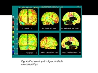 Fig. 2 Niño normal 9 años. Igual escala de
colores que Fig.1
 