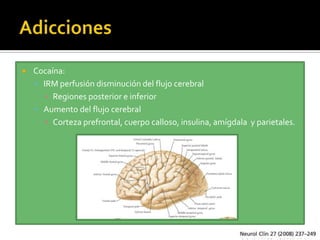    Cocaína:
     IRM perfusión disminución del flujo cerebral
       ▪ Regiones posterior e inferior
     Aumento del flujo cerebral
       ▪ Corteza prefrontal, cuerpo calloso, insulina, amígdala y parietales.
 