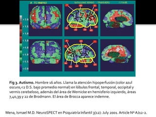 Fig 3. Autismo. Hombre 16 años. Llama la atención hipoperfusión (color azul
  oscuro,<2 D.S. bajo promedio normal) en lóbulos frontal, temporal, occipital y
  vermis cerebeloso, además del área de Wernicke en hemisferio izquierdo, áreas
  7,40,39 y 22 de Brodmann. El área de Brocca aparece indemne.



Mena, Ismael M.D. NeuroSPECT en Psiquiatría Infantil 3(12): July 2001. Article Nº AJ12-2.
 