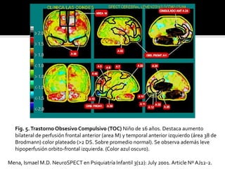 Fig. 5. Trastorno Obsesivo Compulsivo (TOC) Niño de 16 años. Destaca aumento
   bilateral de perfusión frontal anterior (area M) y temporal anterior izquierdo (área 38 de
   Brodmann) color plateado (>2 DS. Sobre promedio normal). Se observa además leve
   hipoperfusión orbito-frontal izquierda. (Color azul oscuro).

Mena, Ismael M.D. NeuroSPECT en Psiquiatría Infantil 3(12): July 2001. Article Nº AJ12-2.
 