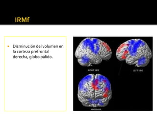    Disminución del volumen en
    la corteza prefrontal
    derecha, globo pálido.
 