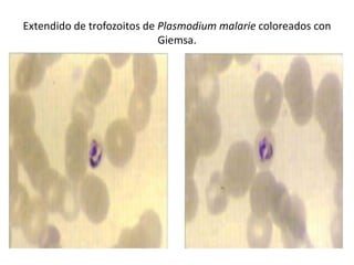 Extendido de trofozoitos de Plasmodium malarie coloreados con
                            Giemsa.
 