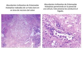 Abundantes trofozoitos de Entamoeba        Abundantes trofozoitos de Entamoeba
                                            histolytica penetrando en la pared de
histolytica rodeados de un halo claro en
                                           una vénula. Este proceso los conducirá al
      un área de necrosis del colon                         hígado.
 