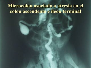 Microcolon asociado a atresia en el colon ascendente e ileon terminal 