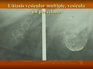 Litiasis vesicular multiple, vesicula en porcelana 
