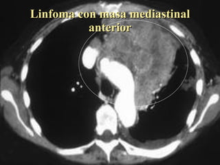 Linfoma con masa mediastinal anterior 