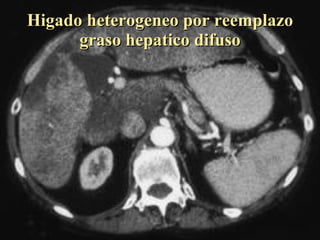 Higado heterogeneo por reemplazo graso hepatico difuso 