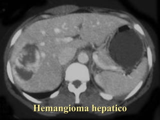 Hemangioma hepatico 