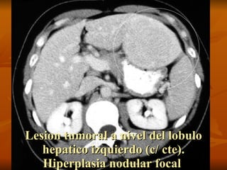 Lesion tumoral a nivel del lobulo hepatico izquierdo (c/ cte). Hiperplasia nodular focal  