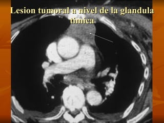 Lesion tumoral a nivel de la glandula timica 