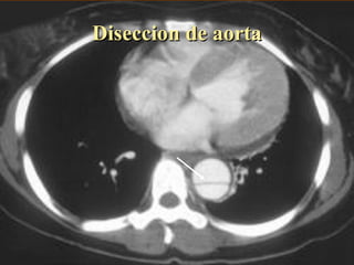 Diseccion de aorta 