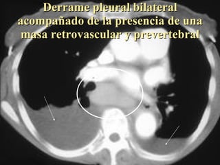 Derrame pleural bilateral acompañado de la presencia de una masa retrovascular y prevertebral 