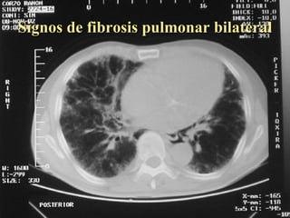 Signos de fibrosis pulmonar bilateral  