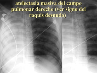 atelectasia masiva del campo pulmonar derecho (ver signo del raquis desnudo) 