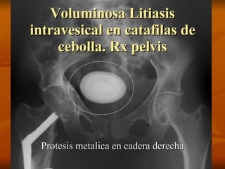 Voluminosa Litiasis intravesical en catafilas de cebolla. Rx pelvis Protesis metalica en cadera derecha 