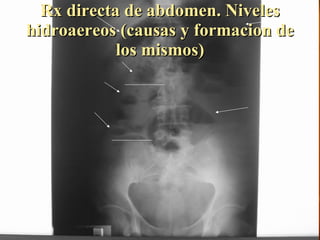 Rx directa de abdomen. Niveles hidroaereos (causas y formacion de los mismos) 
