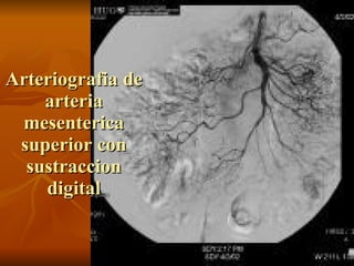 Arteriografia de arteria mesenterica superior con sustraccion digital 