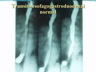 Transito esofagogastroduodenal normal 