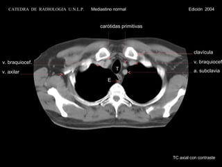 TC axial con contraste v. braquiocef. T E carótidas primitivas a. subclavia v. braquiocef. v. axilar clavícula CATEDRA  DE  RADIOLOGIA  U.N.L.P.   Mediastino normal  Edición  2004 