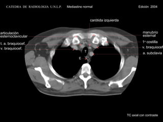 v. braquiocef. T E a. subclavia carótida izquierda t. a. braquiocef. v. braquiocef. manubrio esternal 1 a  costilla articulación esternoclavicular TC axial con contraste CATEDRA  DE  RADIOLOGIA  U.N.L.P.   Mediastino normal  Edición  2004 