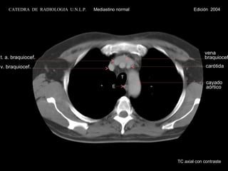 vena braquiocef. T E cayado  aórtico carótida t. a. braquiocef. v. braquiocef. TC axial con contraste CATEDRA  DE  RADIOLOGIA  U.N.L.P.   Mediastino normal  Edición  2004 