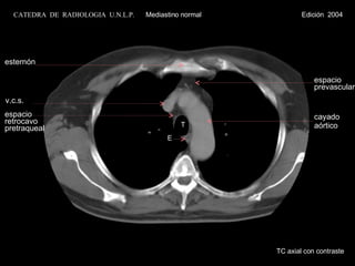 T E v.c.s. cayado aórtico espacio prevascular esternón espacio retrocavo pretraqueal TC axial con contraste CATEDRA  DE  RADIOLOGIA  U.N.L.P.   Mediastino normal  Edición  2004 