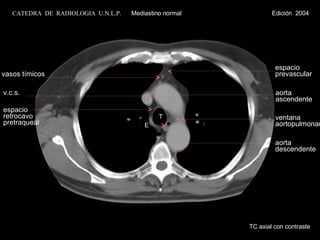 T v.c.s. espacio  retrocavo pretraqueal E espacio prevascular aorta  ascendente ventana  aortopulmonar aorta descendente vasos tímicos TC axial con contraste CATEDRA  DE  RADIOLOGIA  U.N.L.P.   Mediastino normal  Edición  2004 